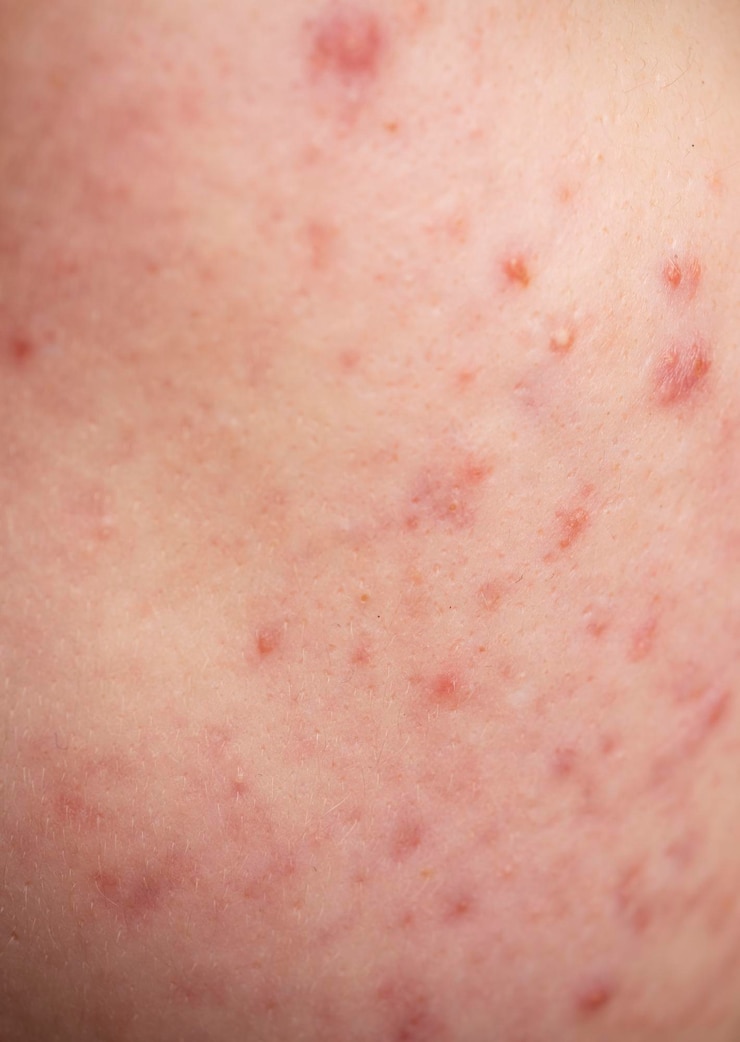 Foto huidtextuur achtergrond close-up acne puistjes behandeling voor huidprobleem huidverzorging puistjes acne poren