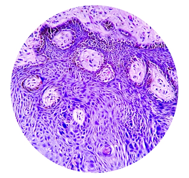 Huidweefselbiopsie Lichen planus. tonen huidweefsel, hyperplastische plaveiselepitheelcel. histologie