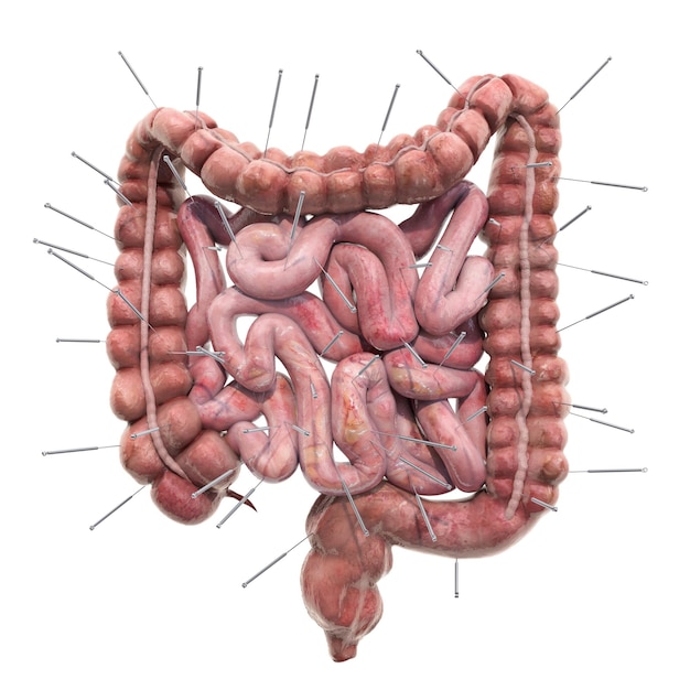 Human bowel with acupuncture needles Acupuncture treatment of intestines concept 3D rendering