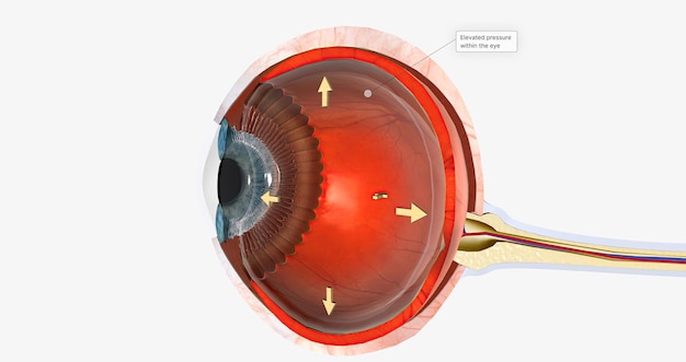 Photo human eye glaucoma eye disease