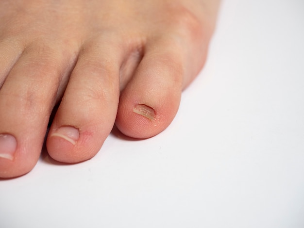 Human foot on a white background with nail problems.