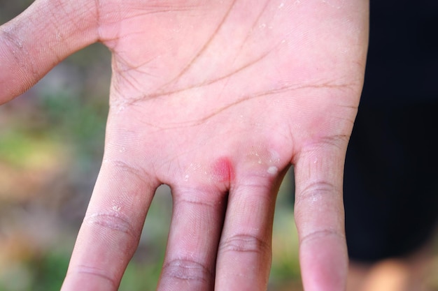 human hand is blistered and inflamed due to heavy use