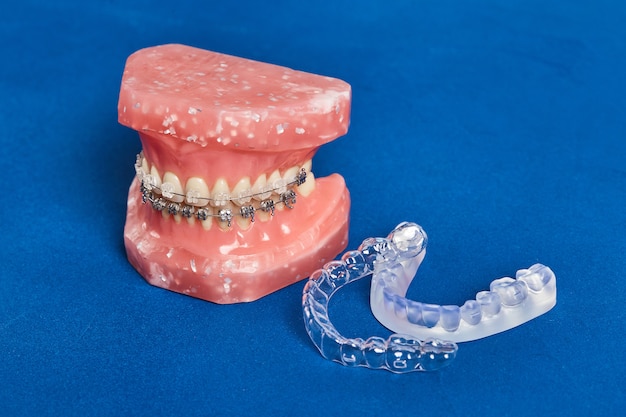 Human jaw or teeth model with metal wired dental braces