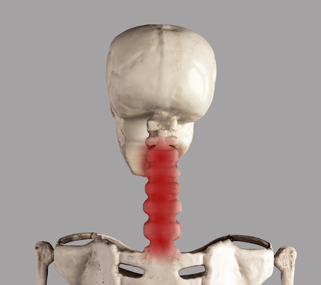 Scheletro umano vertebrato cervicale con punto rosso rigidità del dolore al collo infiammazione lesioni postura scorretta conseguenze di uso eccessivo problemi di salute concetto di anatomia