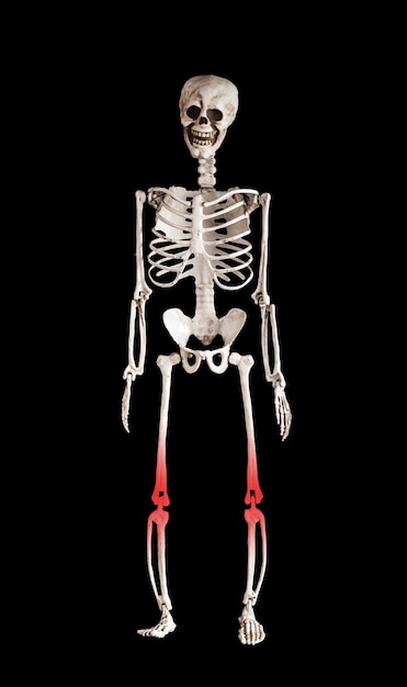 Human skeleton with red knees Leg pain caused by overuse injury Painful kneecap muscle strain Health problems medical conditions concept