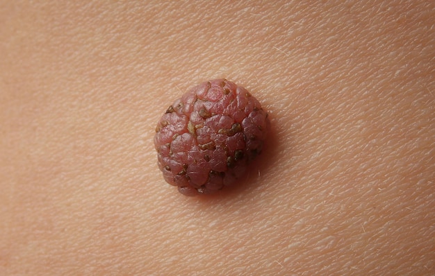 Human skin with birthmark closeup