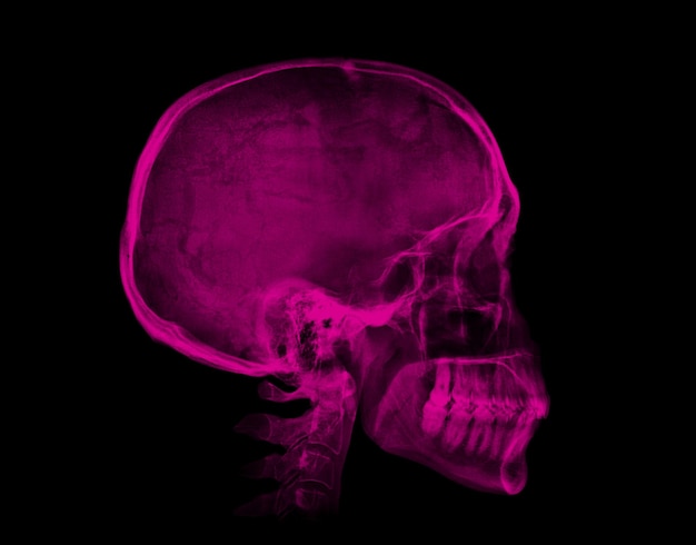 Human skull Pink Xray image isolated on black background