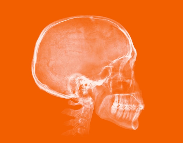 Рентгеновское изображение черепа человека изолировано на оранжевом фоне