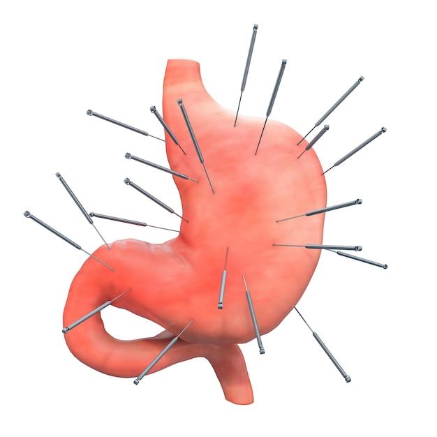 Human stomach with acupuncture needles Acupuncture treatment of stomach concept 3D rendering