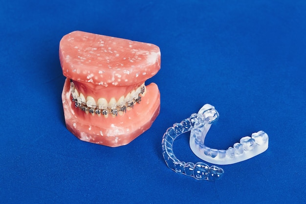 Modello di denti umani con parentesi graffe dentali metalliche