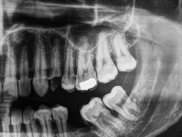 Human teeth xray in black and white