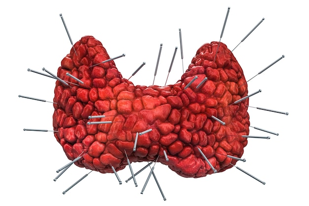 Human thyroid with acupuncture needles Acupuncture treatment of thyroid concept 3D rendering