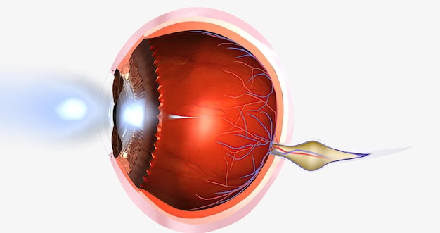 hyperopia is a common visual condition in which the eye's ability to focus on nearby objects is impaired