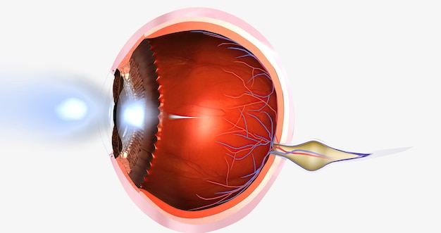 Photo hyperopia is a common visual condition in which the eye's ability to focus on nearby objects is impaired