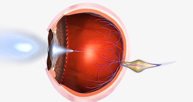 hyperopia is a common visual condition in which the eye's ability to focus on nearby objects is impaired