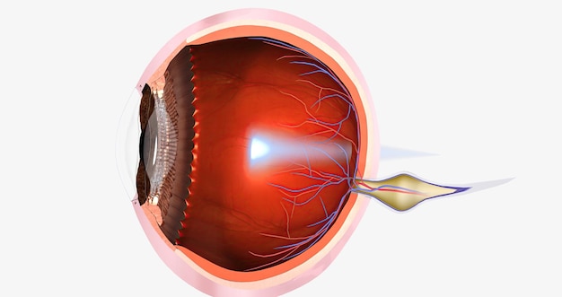 hyperopia is a common visual condition in which the eye's ability to focus on nearby objects is impaired
