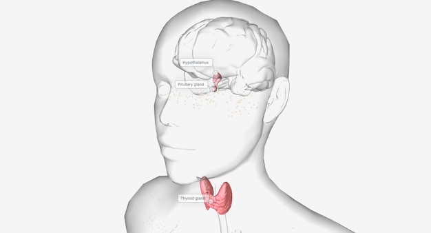 hyperthyroidism is an overproduction of thyroid hormones