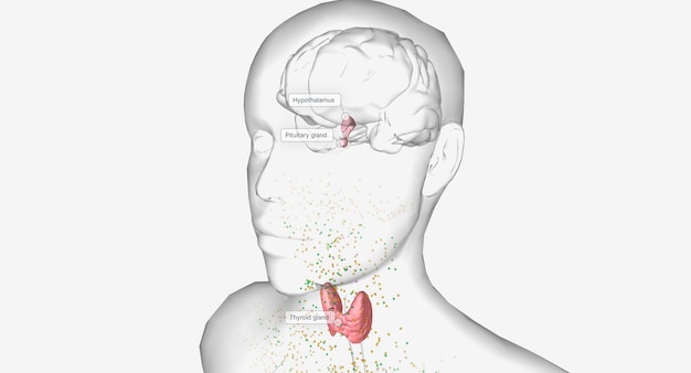 hyperthyroidism is an overproduction of thyroid hormones