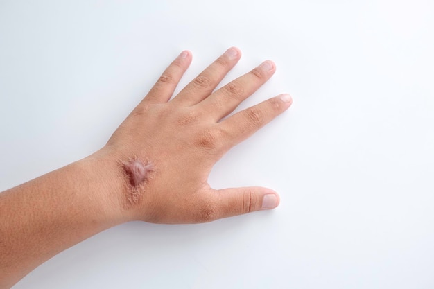 Hypertrophic Keloid scar on hand back of young woman on white background