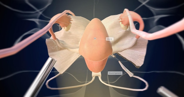 Hysterectomie De ronde ligamenten worden doorgesneden en losgemaakt van de baarmoeder