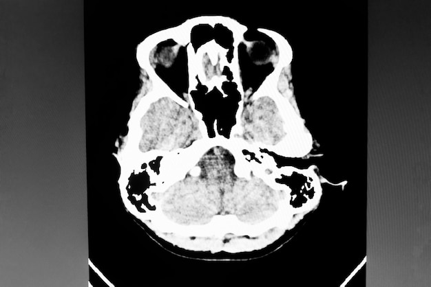 Фото Изображение компьютерной томографии головного мозга
