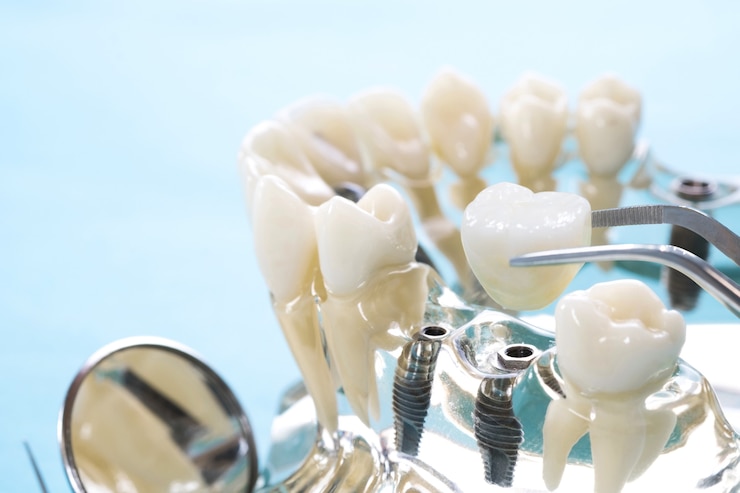 Implan model tooth support fix bridge implan and crown.