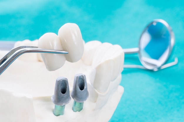 Implan model tooth support fix bridge implan and crown.