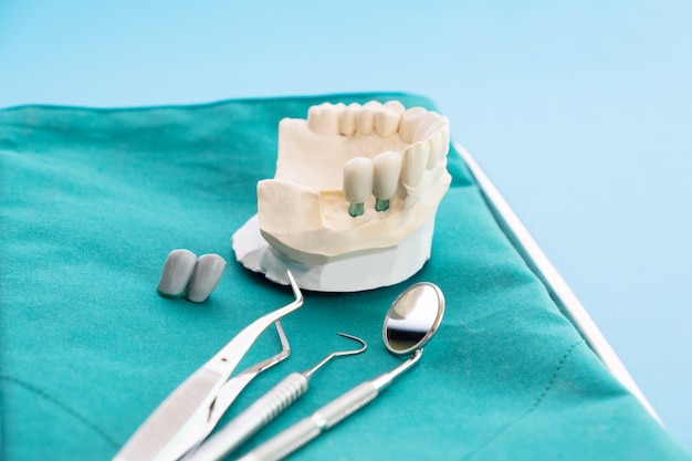 Implan model tooth support fix bridge implan and crown.