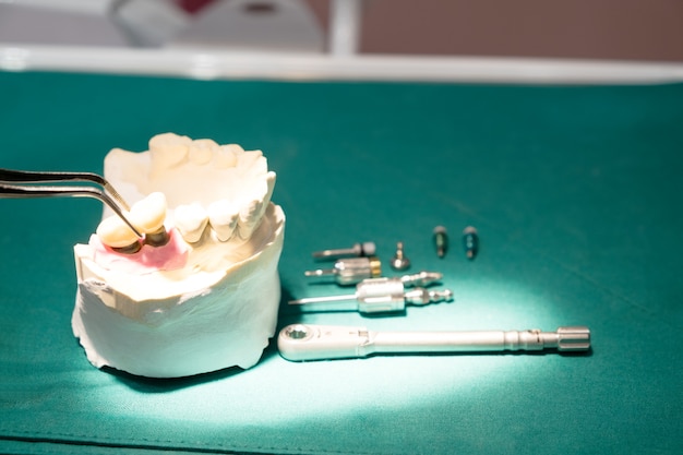 Модель импланта зубной опоры фиксирует мостовой имплант и коронку.