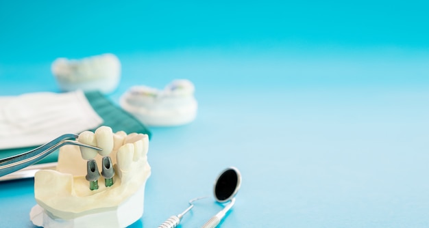 Модель импланта зубной опоры фиксирует мостовой имплант и коронку.