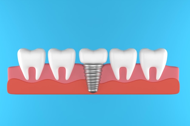 Vite metallica dentale implantare