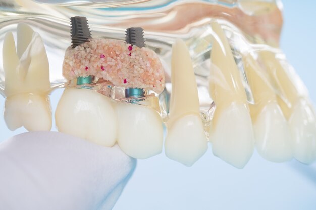 Foto modello implantare e ortodontico per lo studente per l'apprendimento del modello didattico che mostra i denti.