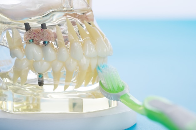 Implant and orthodontic model for student to learning teaching model showing teeth.