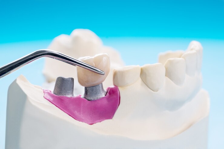 Implant Prosthodontics or Prosthetic