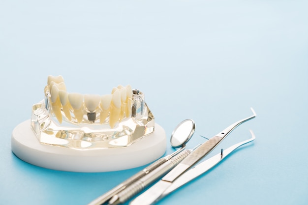 Implantaat en orthodontisch model voor student om leermodel te leren dat tanden toont.