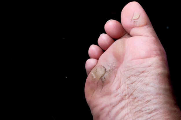 Infection of man feet