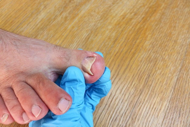 Photo ingrown toenail on foot doctor examines thumb