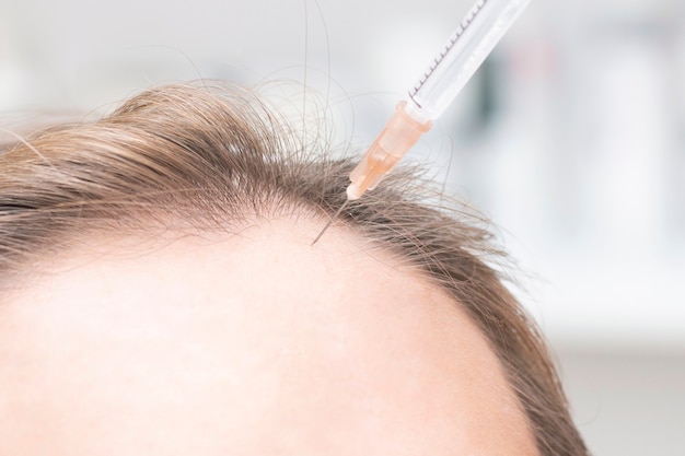 Iniettare con una siringa nelle radici dei capelli per la rigenerazione. stimola la crescita dei capelli. processo di terapia prp. problema di perdita di capelli