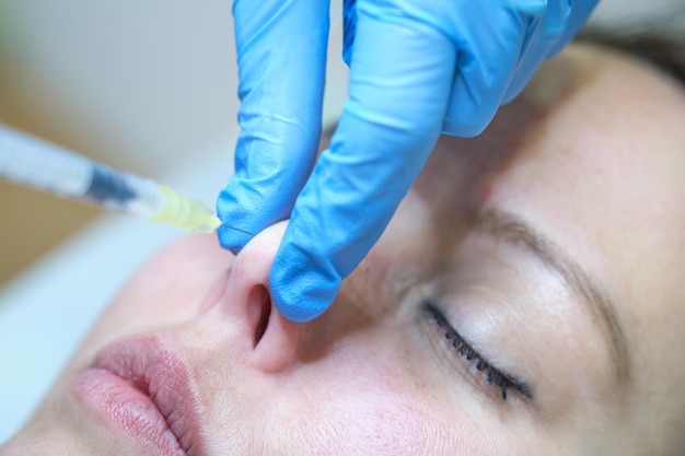 Injecting botulinum toxin for elevation of the nasal tip in the nose of a young girl