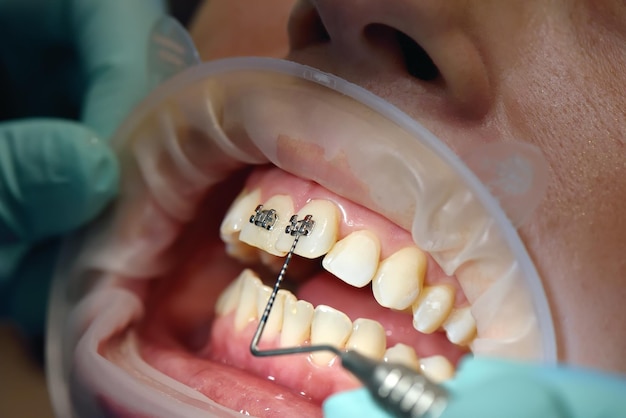 Inspection Of Braces