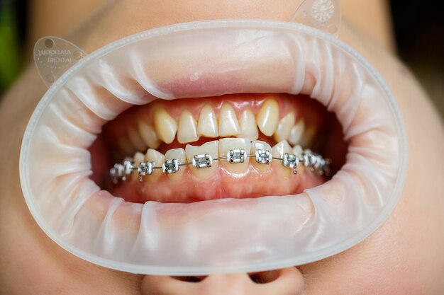 Installation of braces on teeth. Orthodontic dental treatment. Close-up of teeth with braces. High quality photo