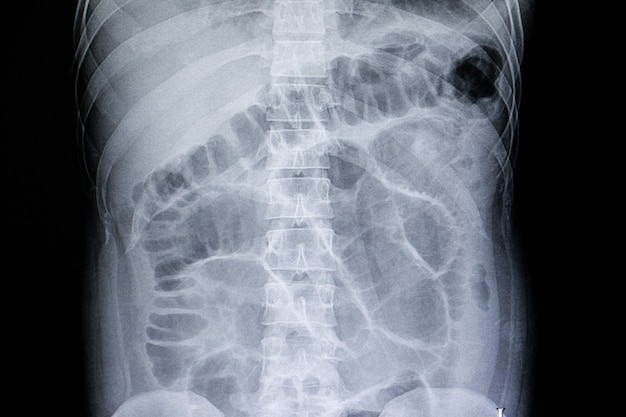 Intestinal obstruction film