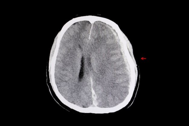 Intracerebral hemorrhage and brain edema