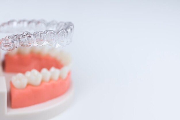 Aligners invisibili e rimovibili per l'allineamento dei denti