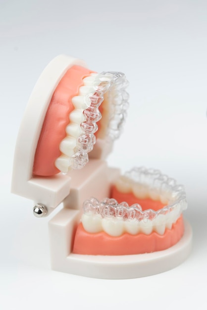 Aligners invisibili e rimovibili per l'allineamento dei denti