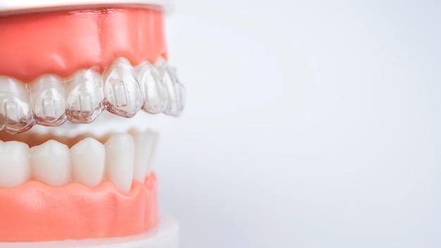 Aligners invisibili e rimovibili per l'allineamento dei denti