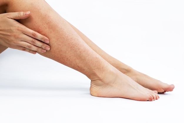 Irritation and redness on sensitive skin after epilation. Woman's legs after depilation with wax