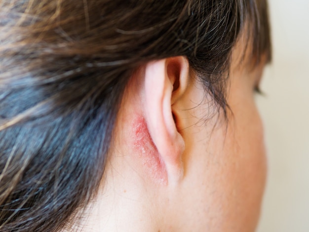 Irritazione sulla pelle dietro l'orecchio. uomo con la pelle traballante. allergia o malattia fungina.