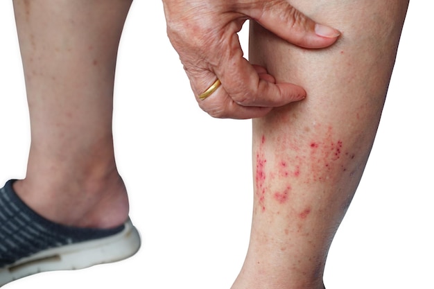 Jeuk met atopische dermatitis huid krabben voor allergische reacties Oude vrouw haar benen krabben