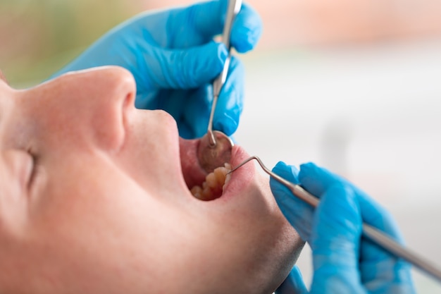 Jonge man een bezoek aan de tandheelkundige kantoor. Tandarts dient beschermende handschoenen in met behulp van echografie om de tanden van de patiënt te reinigen. Close-up van de open mond.